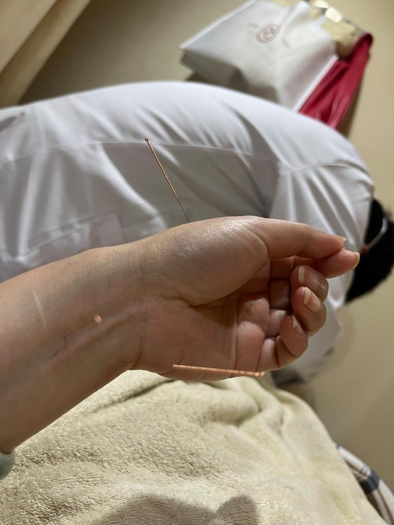 针灸治疗失眠的效果和优势